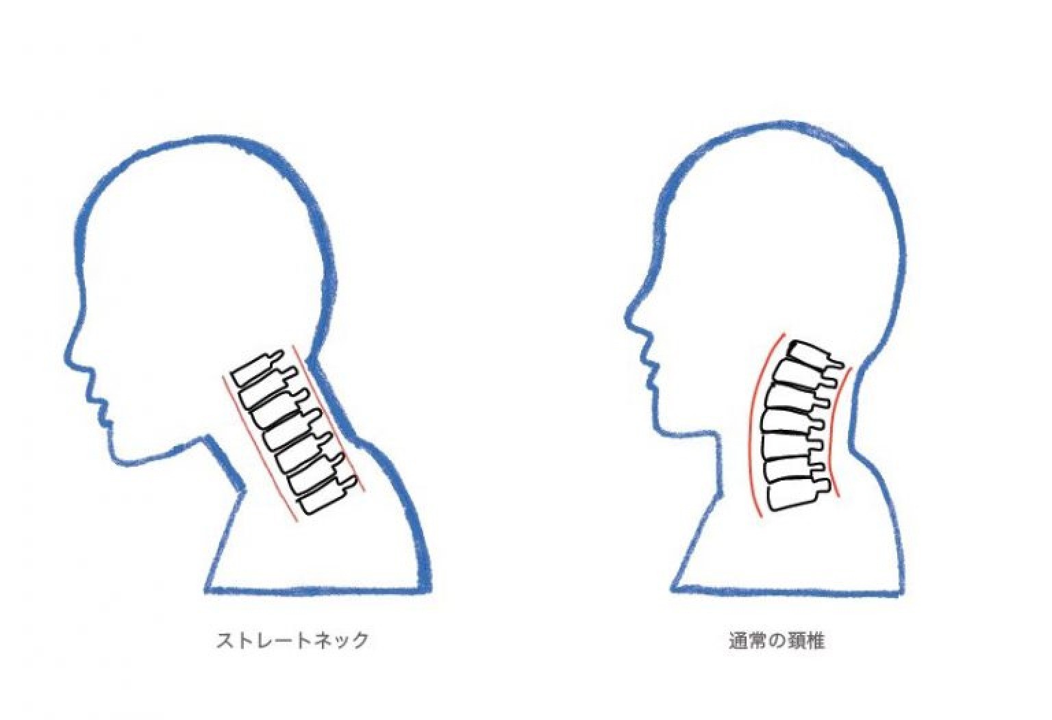 ストレートネックの画像