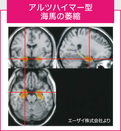 アルツハイマー型 海馬の萎縮