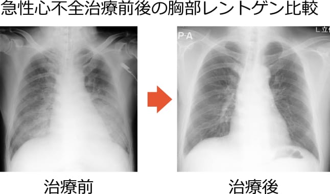  COPD は CHF を引き起こす可能性がありますか?