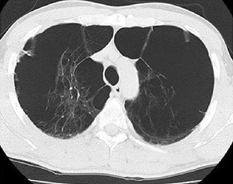 MCKDはどのように治療されますか?