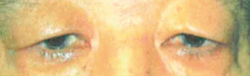 眼瞼皮膚弛緩症について02