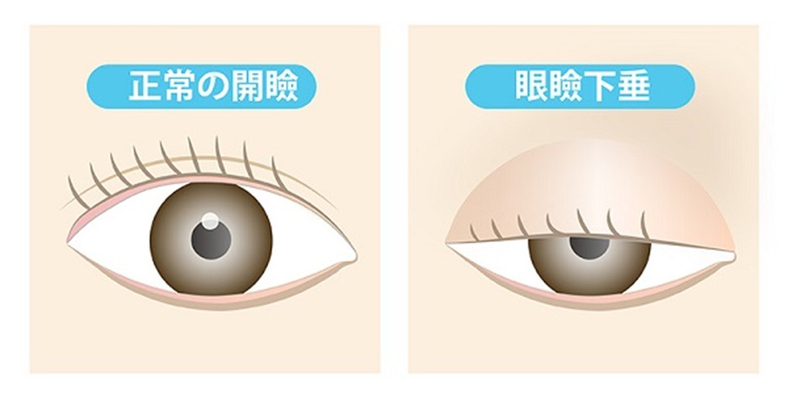 眼瞼下垂症について