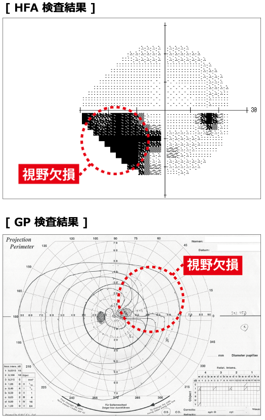 緑内障 md 値 とは